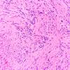 15B Schwannoma (Case 15) H&E 20X