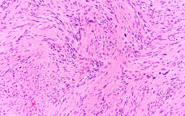 15B Schwannoma (Case 15) H&E 20X