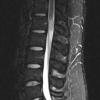 16A1 Schwannoma (Case 16) T2 TIRM - Copy