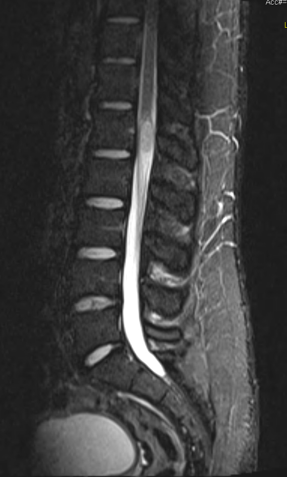 16A1 Schwannoma (Case 16) T2 TIRM - Copy