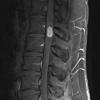 16A2 Schwannoma (Case 16) T1 W 2 - Copy