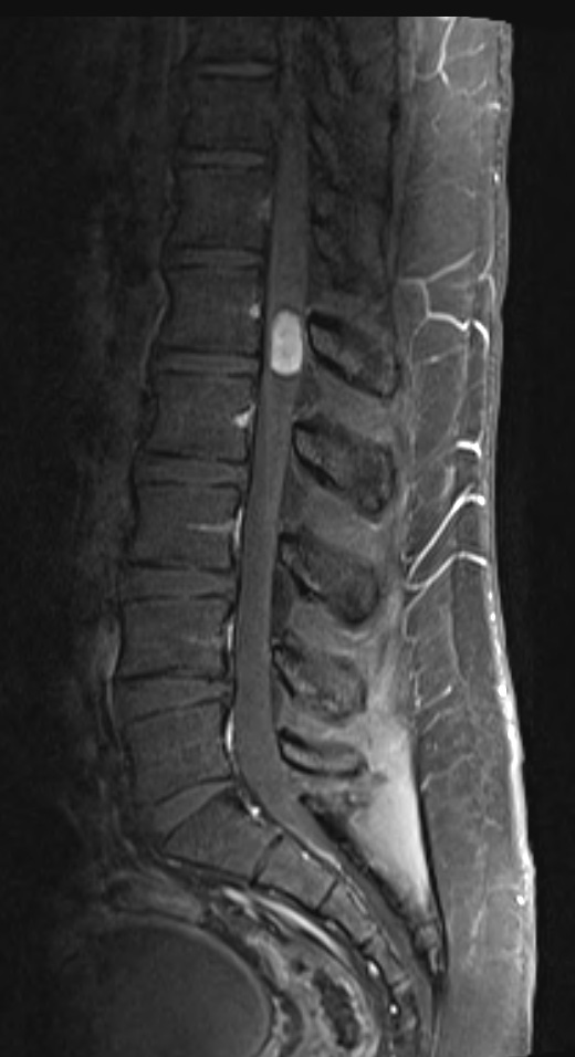 16A2 Schwannoma (Case 16) T1 W 2 - Copy