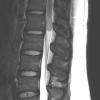 16A3 Schwannoma (Case 16) T2 1 - Copy