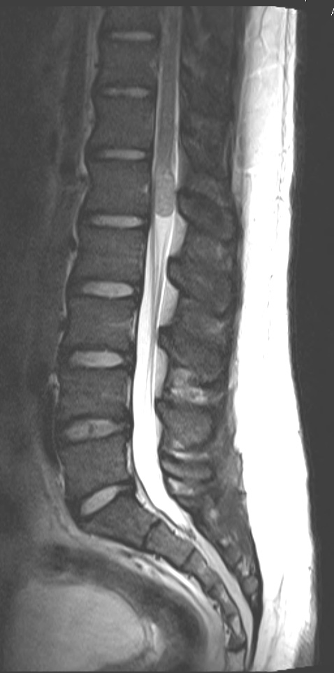 16A3 Schwannoma (Case 16) T2 1 - Copy