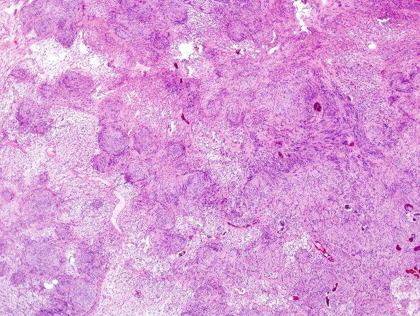 16B2 Schwannoma (Case 16) H&E 1