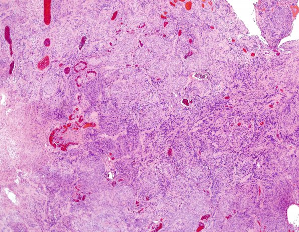 16B3 Schwannoma (Case 16) H&E 8