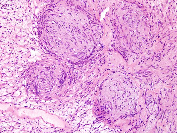 16B4 Schwannoma (Case 16) H&E 3