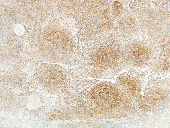 16D1 Schwannoma (Case 16) Coll IV 3