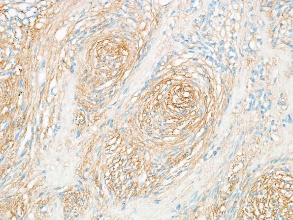 16D2 Schwannoma (Case 16) Coll IV 1