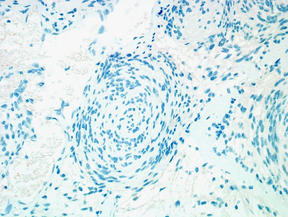 16E Schwannoma (Case 16) EMA 1