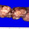 17A1 Schwannoma (Case 17) Gross_1