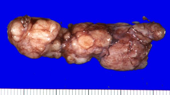 17A1 Schwannoma (Case 17) Gross_1