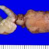 17A2 Schwannoma (Case 17) Gross_2