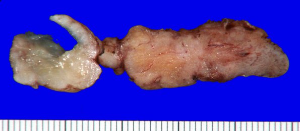 17A2 Schwannoma (Case 17) Gross_2