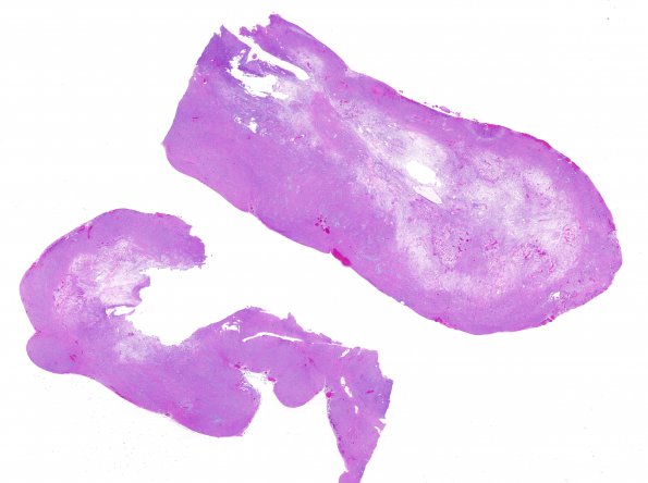 17B1 Schwannoma (Case 17) H&E whole mount