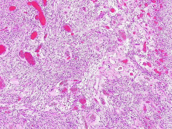 17B2 Schwannoma (Case 17) H&E 2.jpg