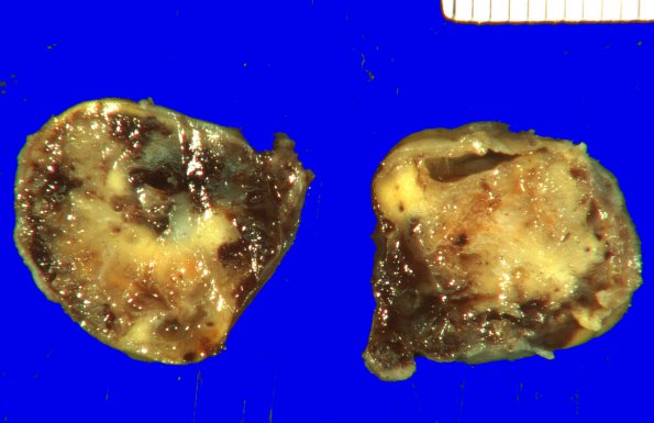 18A Schwannoma (Case 18) 3