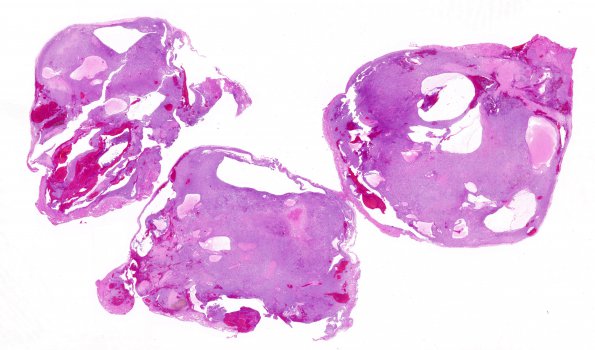 18B1 Schwannoma (Case 18) H&E whole mount