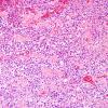 18B2 Schwannoma (Case 18) Area A H&E 2.jpg