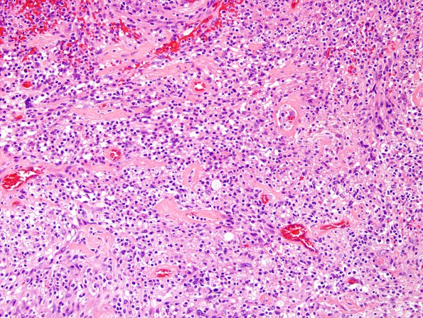 18B2 Schwannoma (Case 18) Area A H&E 2.jpg