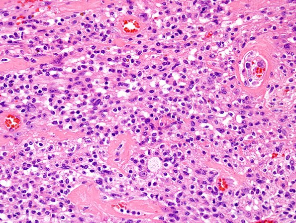 18B3 Schwannoma (Case 18) Area A H&E 1.jpg