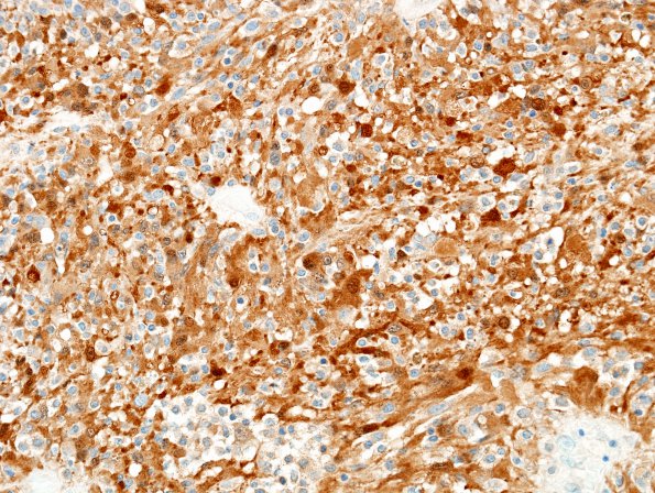 18C2 Schwannoma (Case 18) Area A S100 2.jpg