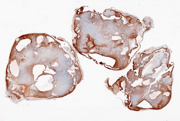 18D1 Schwannoma (Case 18) Coll IV whole mount