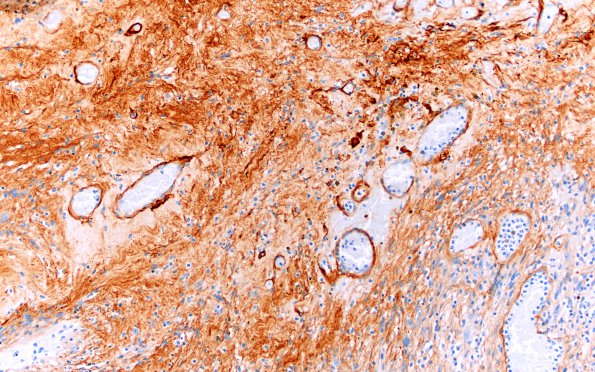 18D2 Schwannoma (Case 18) Coll IV 20X