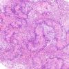 19A1 Schwannoma w impressive Verocay (Case 19) H&E 4.jpg