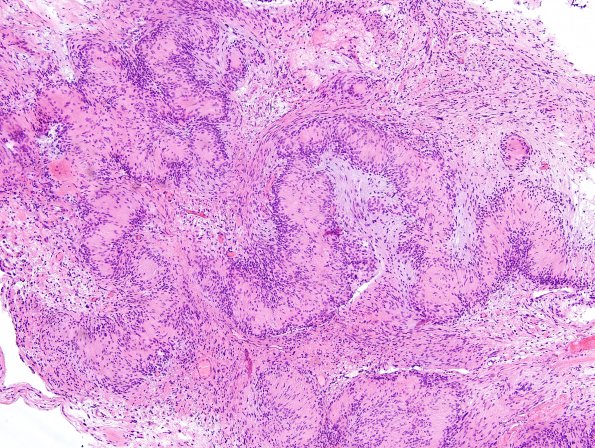 19A1 Schwannoma w impressive Verocay (Case 19) H&E 4.jpg