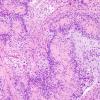 19A2 Schwannoma w impressive Verocay (Case 19) H&E 5.jpg