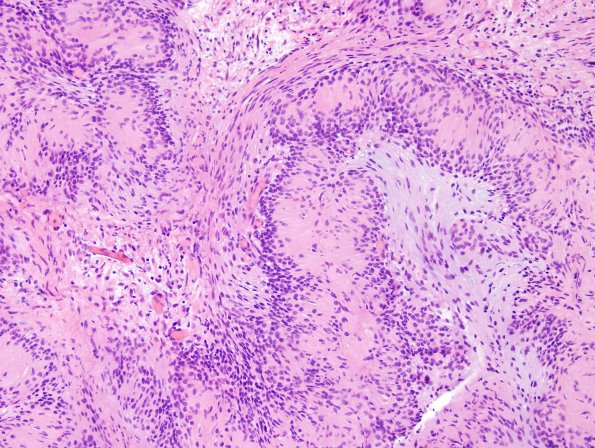 19A2 Schwannoma w impressive Verocay (Case 19) H&E 5.jpg