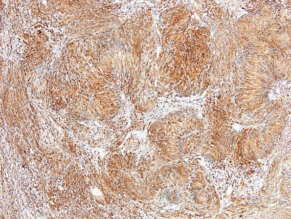 19B1 Schwannoma w impressive Verocay (Case 19) S100 2.jpg