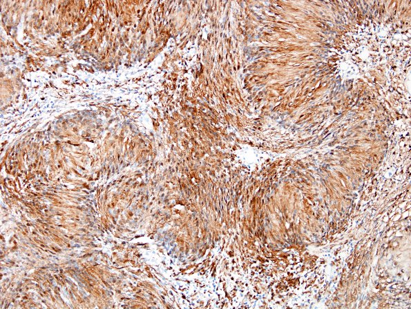 19B2 Schwannoma w impressive Verocay (Case 19) S100 1.jpg