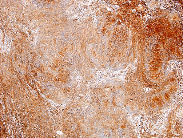 19C1 Schwannoma w impressive Verocay (Case 19) Coll IV 4.jpg