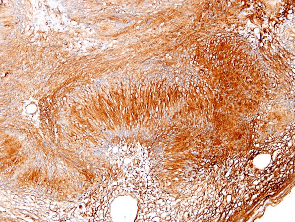 19C2 Schwannoma w impressive Verocay (Case 19) Coll IV 2.jpg