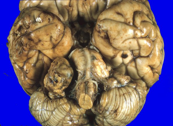 1A1 Schwannoma (Case 1A) 1