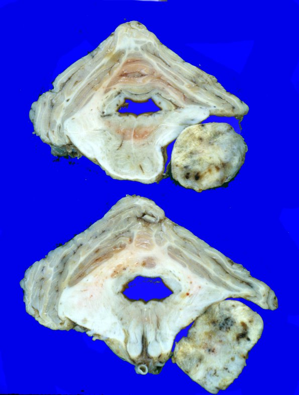 1A2 Schwannoma (Case 1A) 2