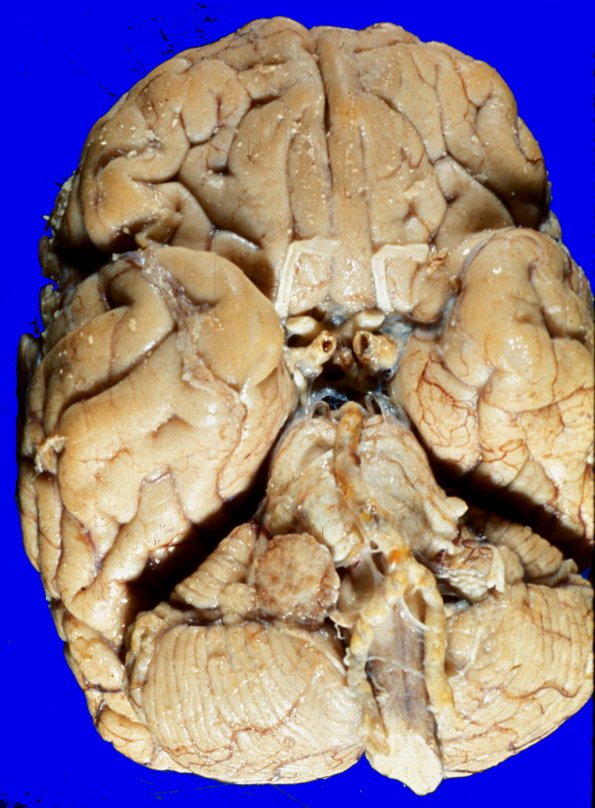 1B1 Schwannoma (Case 1B) a