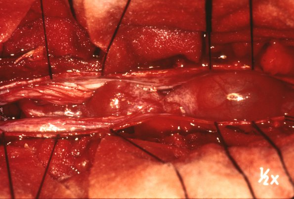 1C Schwannoma, Spinal cord (Case 1C)