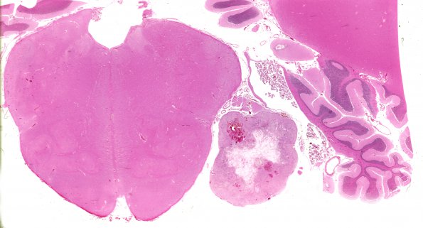 1D1 Schwannoma (Case 1D)