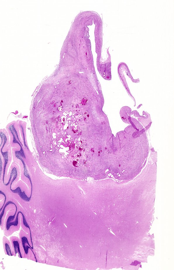 1D3 Schwannoma (Case 1D3) H&E 1