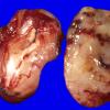 1F Schwannoma (Case 1F) 3 neurofibromatosis