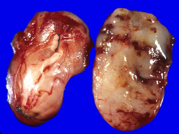 1F Schwannoma (Case 1F) 3 neurofibromatosis