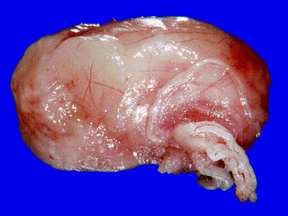 1G1 Schwannoma (Case 1G) Gross_3