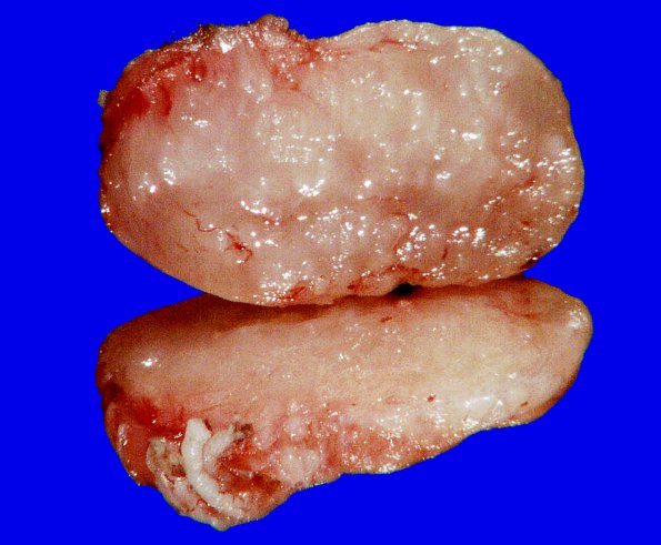 1G2 Schwannoma (Case 1G) Gross_4