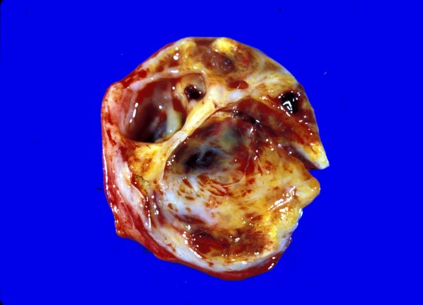 1H Schwannoma (Case 1H) gross 1