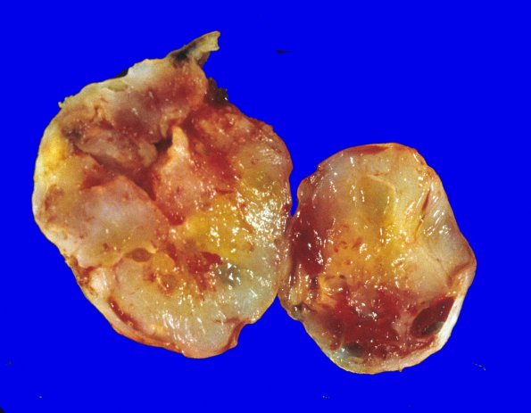 1I Schwannoma (Case 1I)