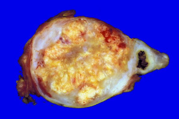 1J Schwannoma (Case 1J) 2