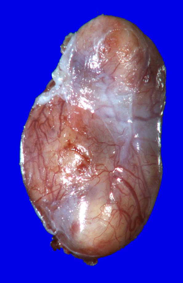 1L1 Schwannoma-Gross images (Case 1L) 3